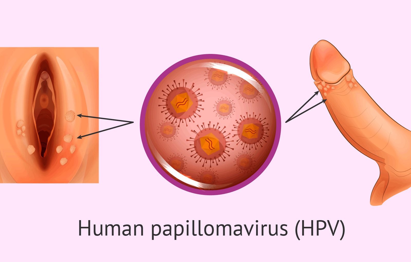 hpv-tedavisi