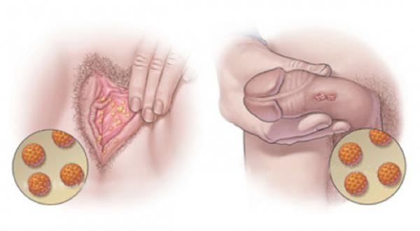 hpv-tedavisi
