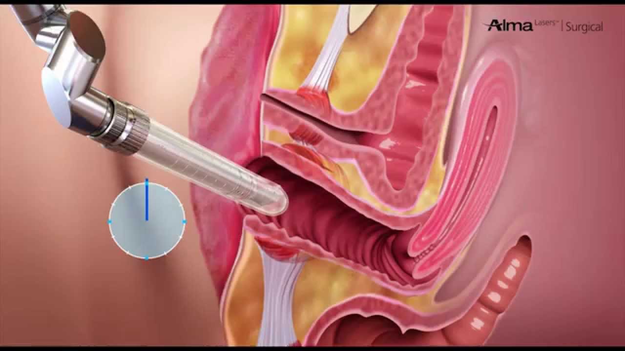 idrar-kacirma-lazer-tedavi-3