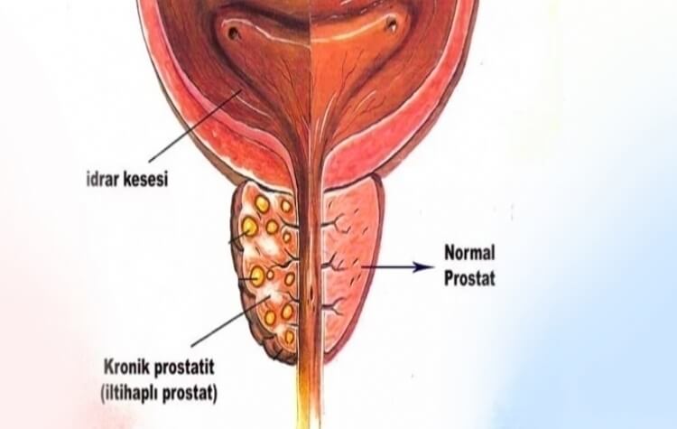 kronik-prostatit-nedir-belirtileri-tani-ve-tedavisi