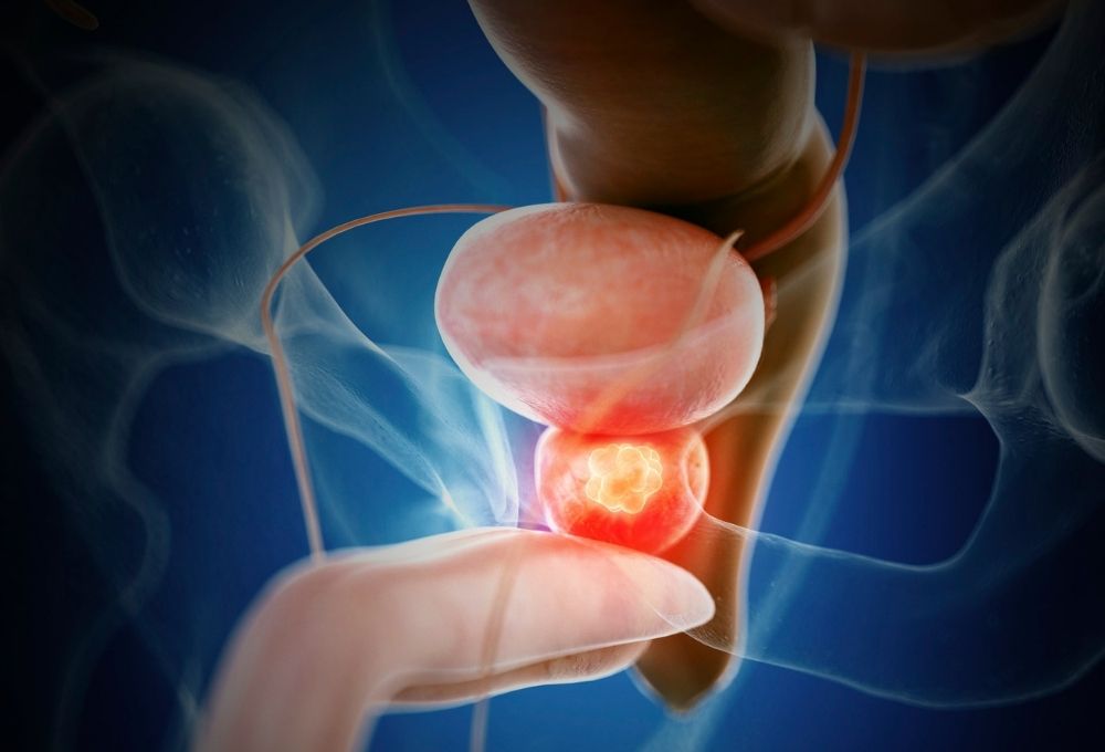 kronik-prostatit-nedir