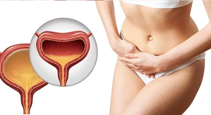 kronik-interstisyel-sistit-nedir kronik-interstisyel-sistit-nedir