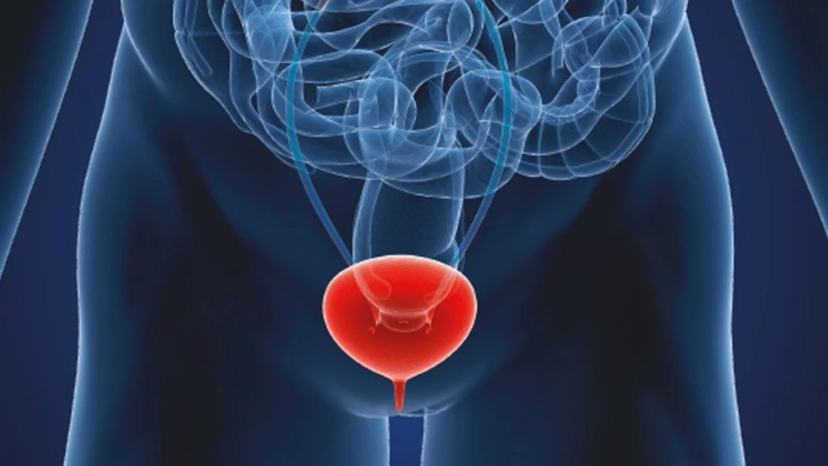 kronik-interstisyel-sistit-nedir kronik-interstisyel-sistit-nedir