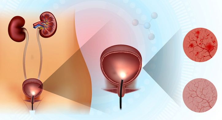 kronik-interstisyel-sistit-nedir kronik-interstisyel-sistit-nedir